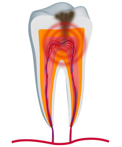 root canals with a Baton Rouge dentist near Prairieville