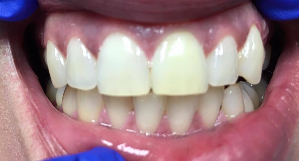 Tooth with root canal and internal bleach for 5 days with a conservative filling. Tooth is now ready for external bleaching to even the teeth out.